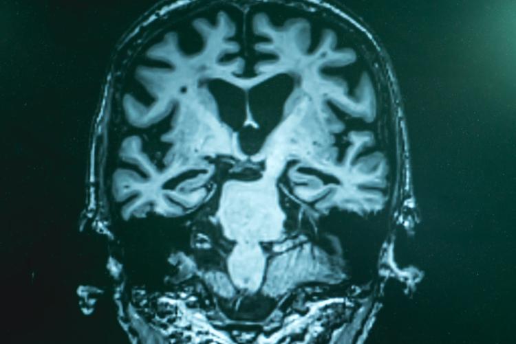 Advanced Alzheimer’s disease can be seen on brain scans, but gathering more data could allow for earlier diagnosis and treatment. Shutterstock/Rakstaput
